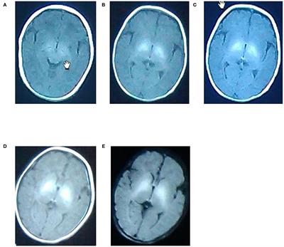 Analysis on the MRI and BAEP Results of Neonatal Brain With Different Levels of Bilirubin